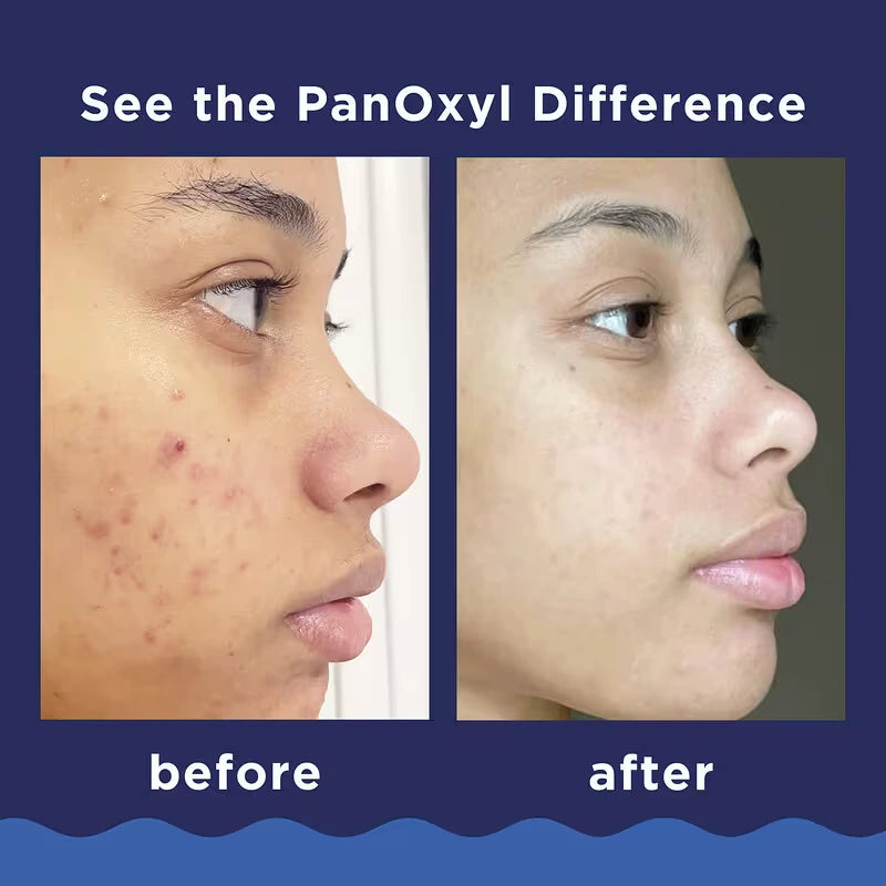 PanOxyl, Acne Foaming Wash For Face & Body, Maximum Strength - 85 g